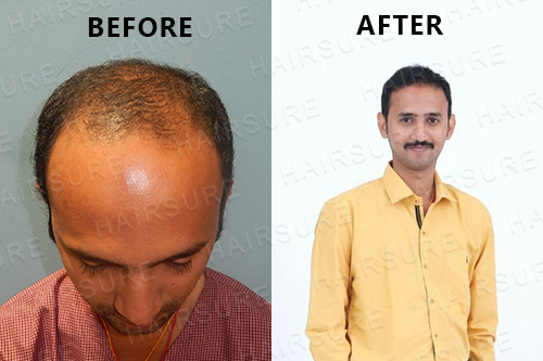 Hair Transplantation Clinic in Hyderabad, Chennai, Bangalore