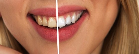 Online Teeth Whitening Scams article cover